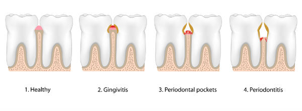 periodontaldiese